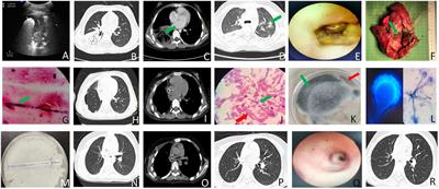 The first child with mixed invasive pulmonary Mucor and Aspergillus infection: a case report and literature review